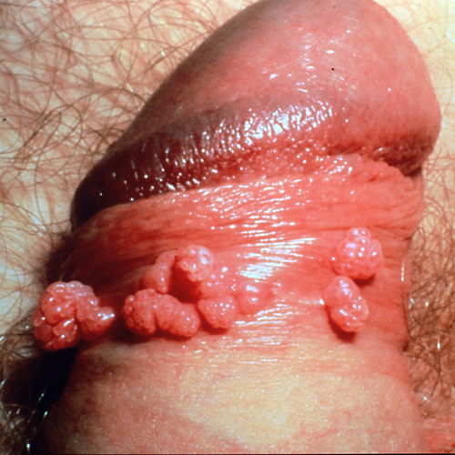 symptoms of genatal warts #10